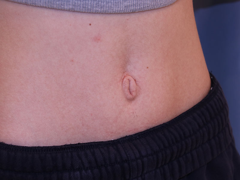 Umbilicoplasty Before and After 07