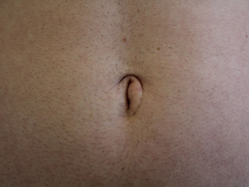 Umbilicoplasty Before and After 10