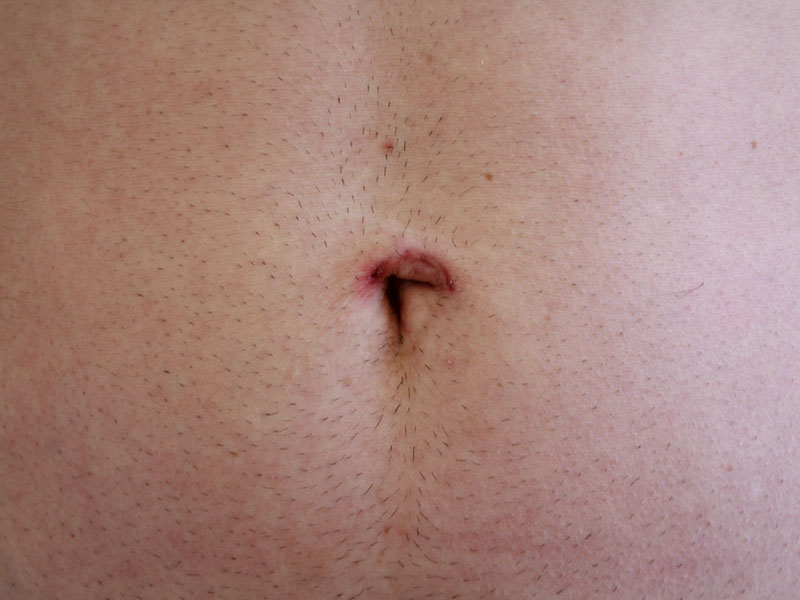 Umbilicoplasty Before and After | Dr. Leslie Stevens