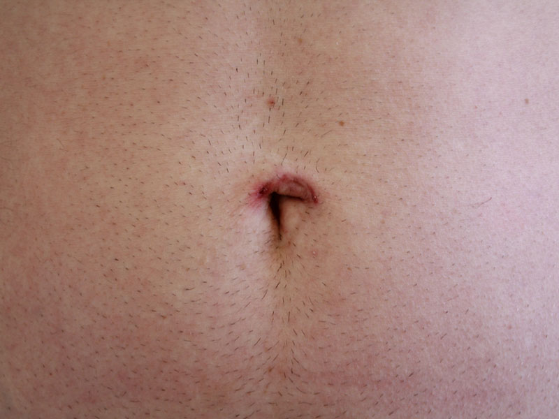 Umbilicoplasty Before and After 12