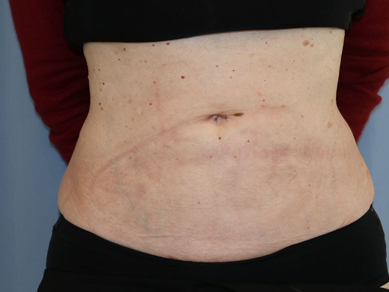 Umbilicoplasty Before and After | Dr. Leslie Stevens