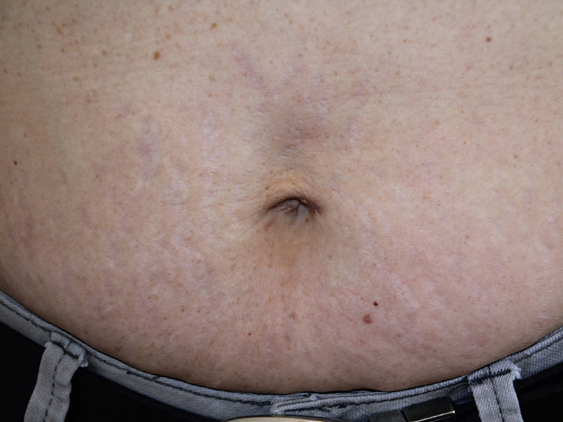 Umbilicoplasty Before and After | Dr. Leslie Stevens