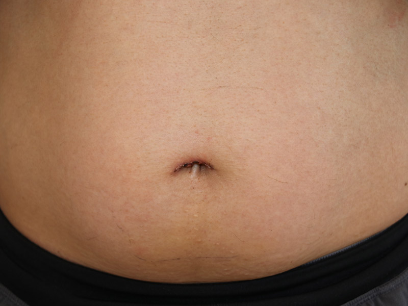 Umbilicoplasty Before and After | Dr. Leslie Stevens