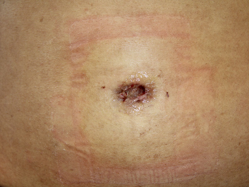 Umbilicoplasty Before and After 11