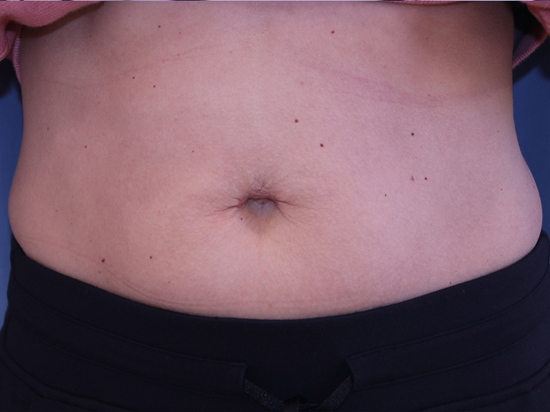 Umbilicoplasty Before and After | Dr. Leslie Stevens