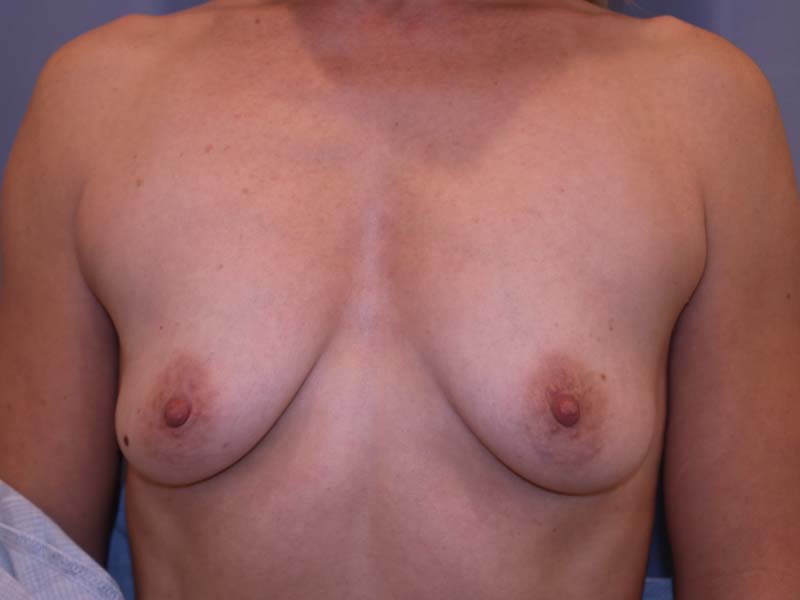 Before Breast Augmentation