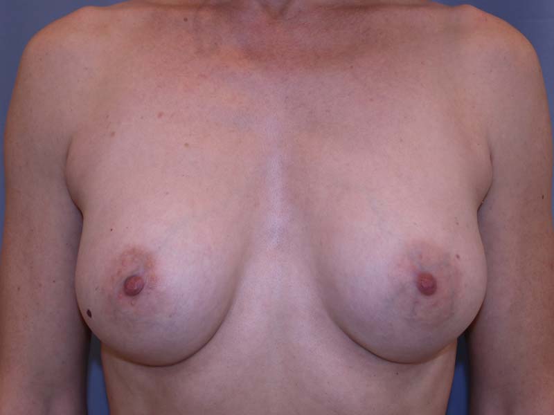 Breast Augmentation Before and After 33