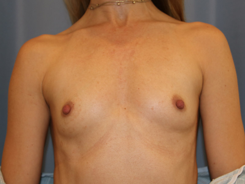 Breast Augmentation Before and After | Dr. Leslie Stevens