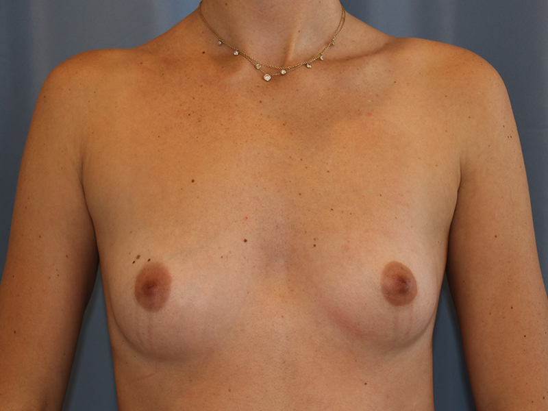 Breast Augmentation Before and After | Dr. Leslie Stevens