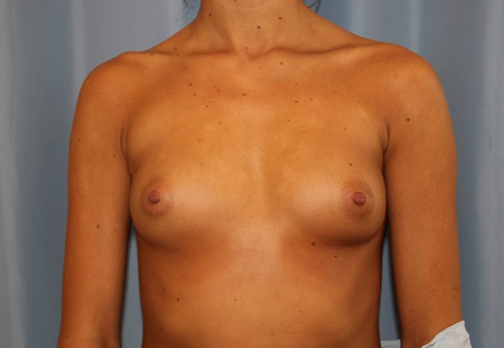 Breast Augmentation Before and After | Dr. Leslie Stevens