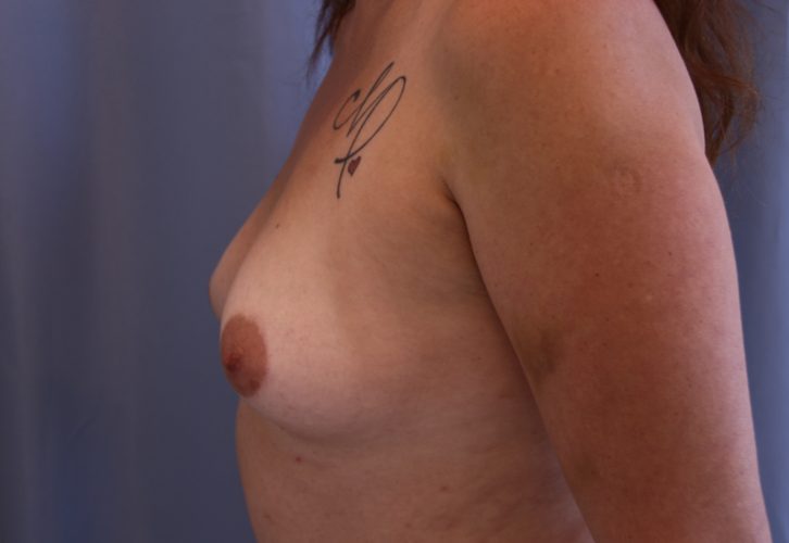 Breast Augmentation Before and After 10