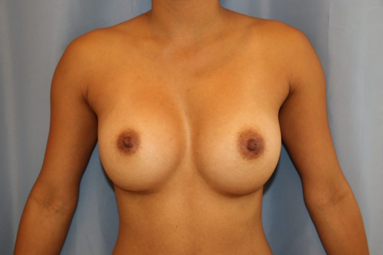 Breast Augmentation Before and After 13