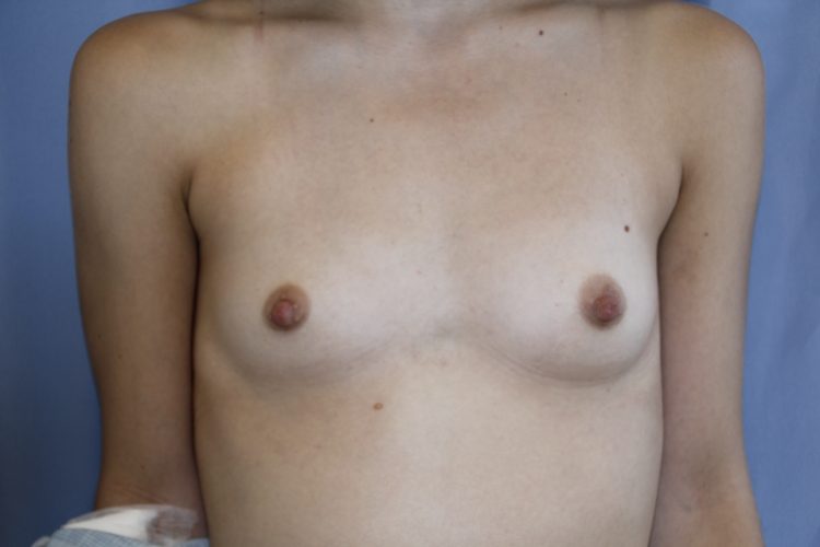 Breast Augmentation Before and After 13