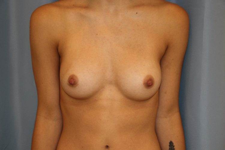 Breast Augmentation Before and After 54