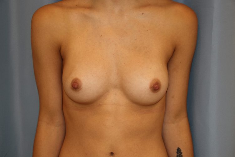 Breast Augmentation Before and After 50