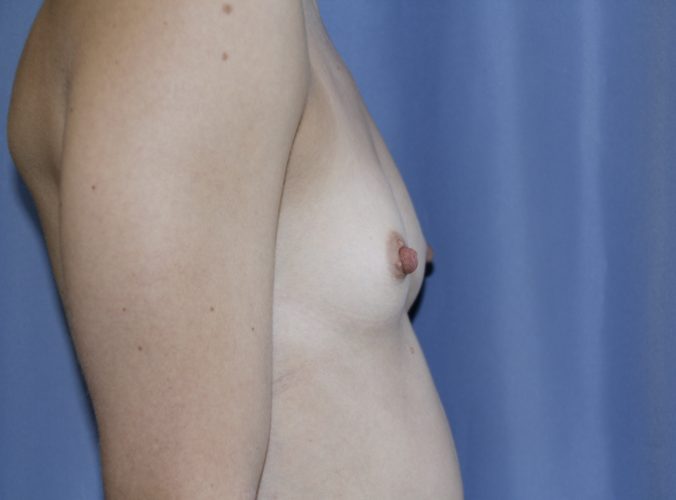 Breast Augmentation Before and After 13