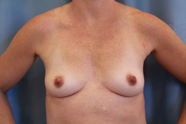 Breast Augmentation Before and After 14