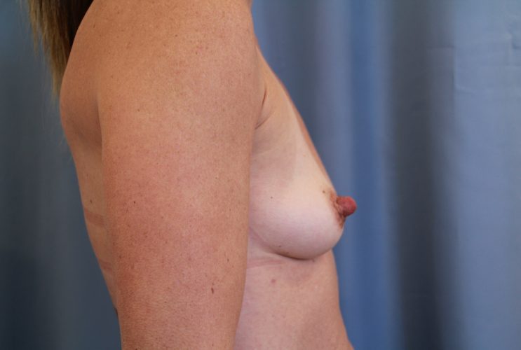 Breast Augmentation Before and After 14