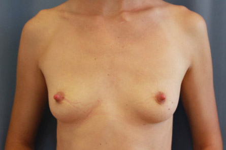 Breast Augmentation Before and After | Dr. Leslie Stevens