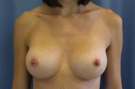 Breast Augmentation Before and After 54