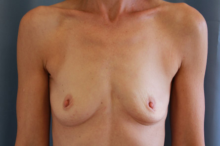 Breast Augmentation Before and After | Dr. Leslie Stevens