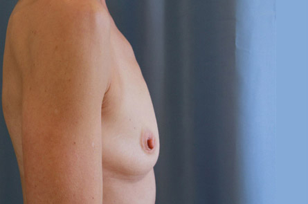Breast Augmentation Before and After 20