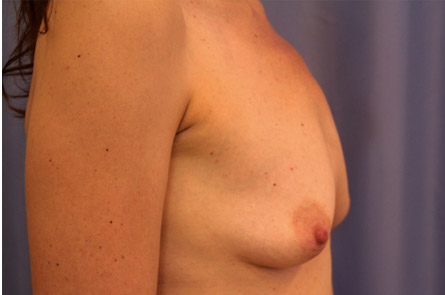 Breast Augmentation Before and After 21