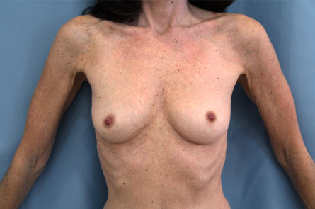 Breast Augmentation Before and After 22