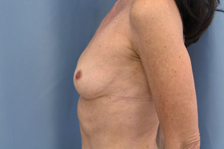 Breast Augmentation Before and After 22