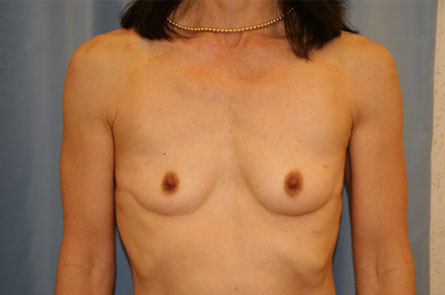 Breast Augmentation Before and After | Dr. Leslie Stevens