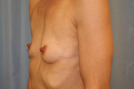 Breast Augmentation Before and After 23