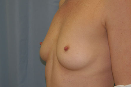 Breast Augmentation Before and After 24