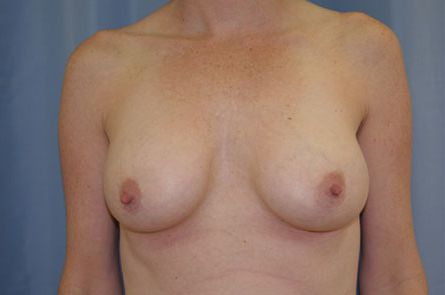 Breast Augmentation Before and After 40