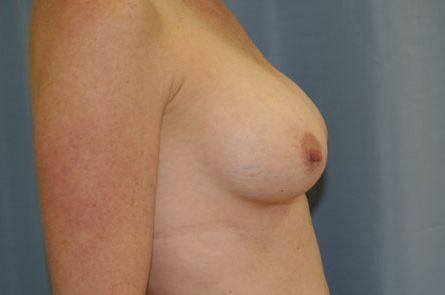 Breast Augmentation Before and After 27