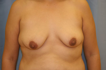 Breast Augmentation Before and After 28