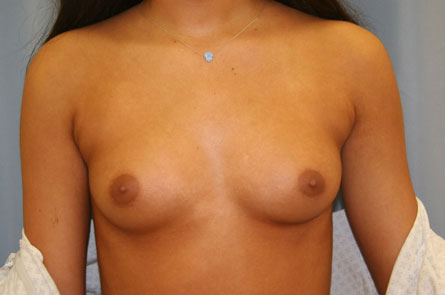 Breast Augmentation Before and After | Dr. Leslie Stevens