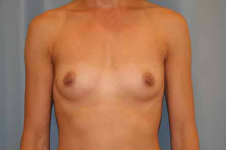 Breast Augmentation Before and After 30