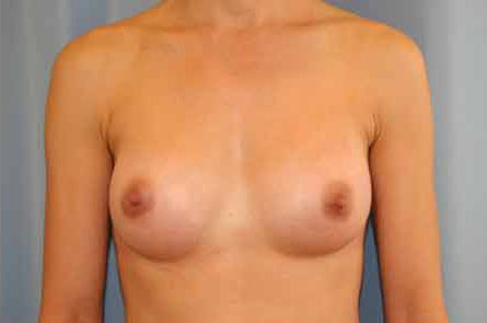 Breast Augmentation Before and After 04