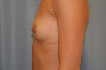 Breast Augmentation Before and After 30