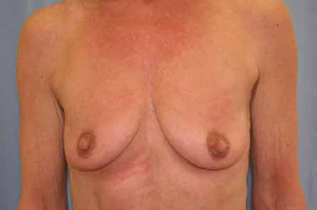 Breast Augmentation Before and After 31