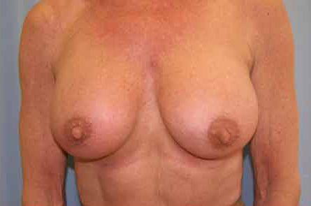 Breast Augmentation Before and After 54