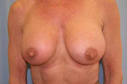 Breast Augmentation Before and After 13