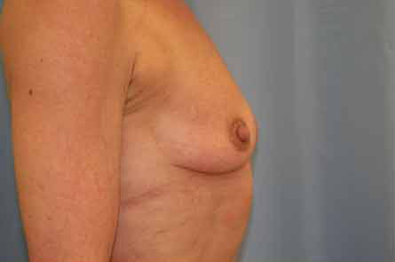 Breast Augmentation Before and After 31