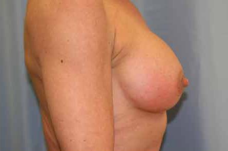 Breast Augmentation Before and After 31