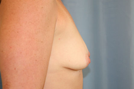 Breast Augmentation Before and After 32