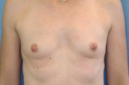 Breast Augmentation Before and After 33