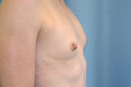 Breast Augmentation Before and After 33