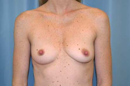 Breast Augmentation Before and After 34