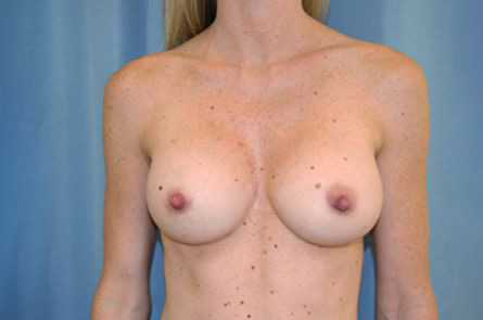 Breast Augmentation Before and After 30