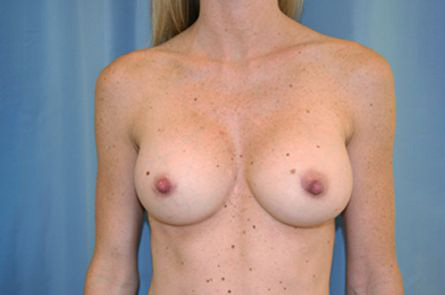 Breast Augmentation Before and After 42